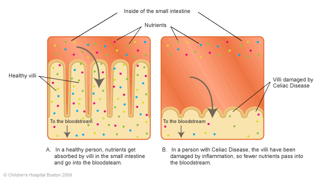 What foods should you avoid if you have celiac disease?