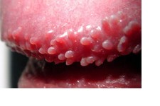 Head penile pimples on Penile Bumps