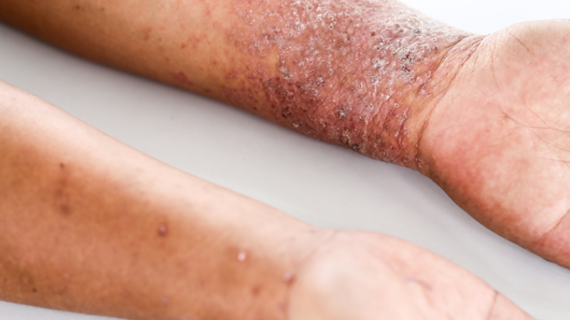 A serious psoriasis rash on the wrist of an individual