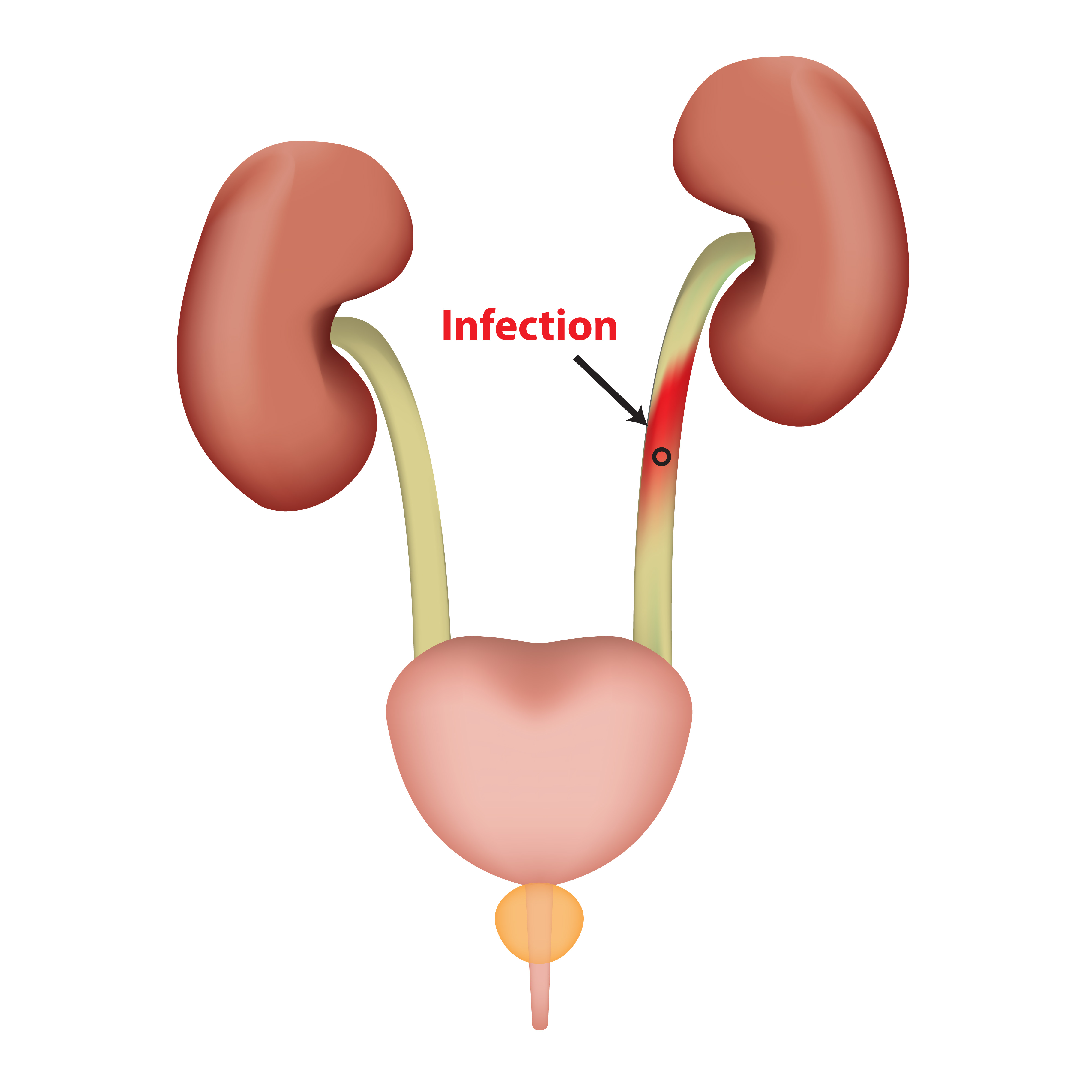 Urinary Tract Infection Uti Young Men S Health