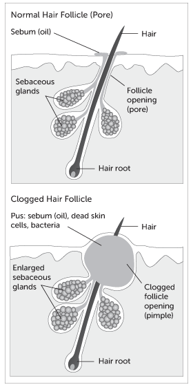 acne illustration