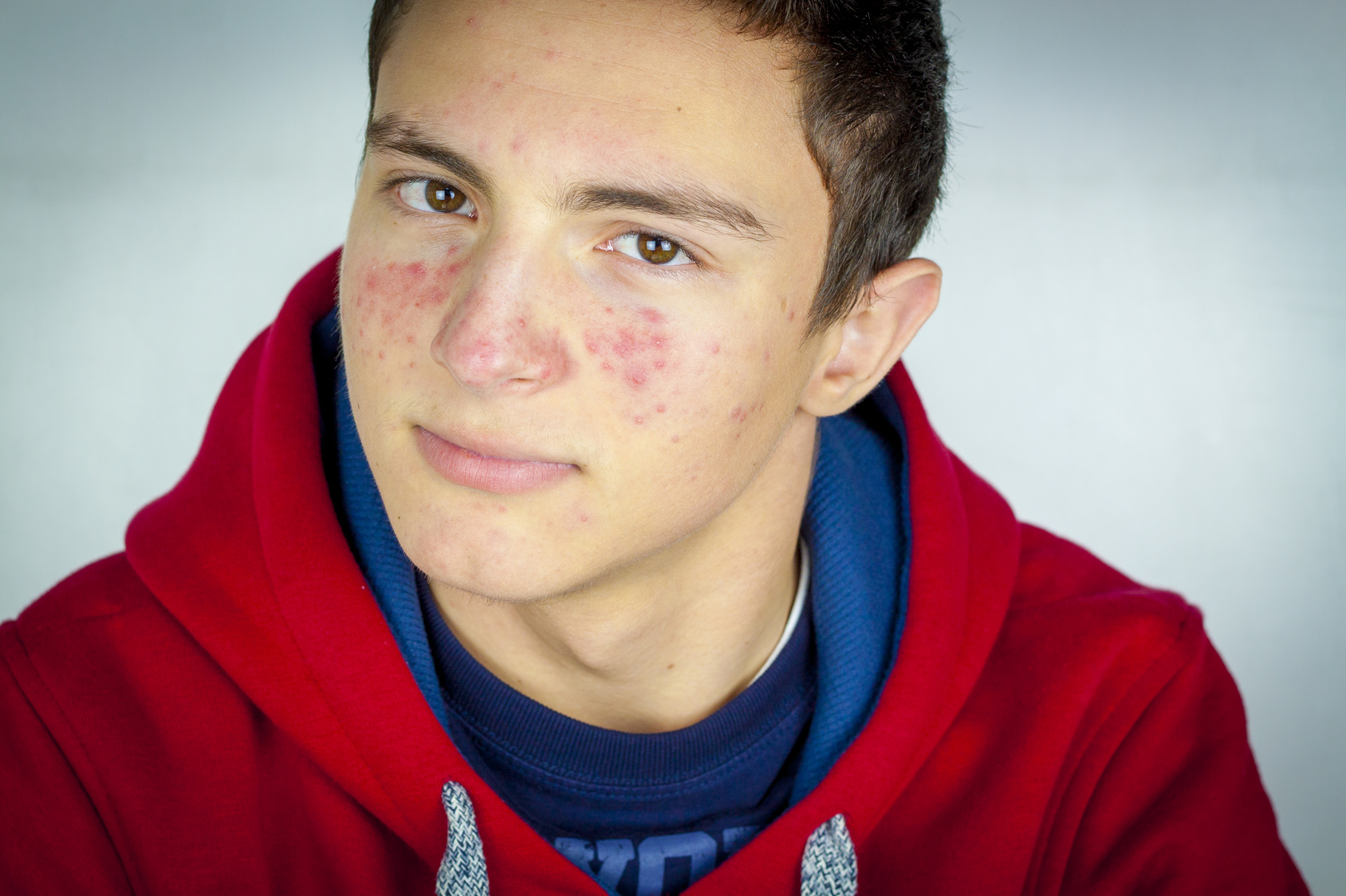 Acne Young Men S Health