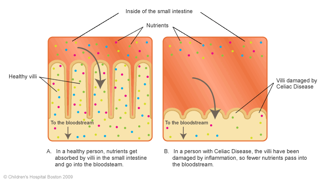 Image of A. In a healthy person, nutrients get absorbed by villi in the small intestine and go into the bloodstream., B. In a person with Celiac Disease, the villi have been damaged by inflammation, so fewer nutrients pass into the bloodstream.