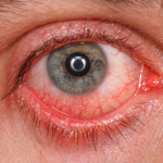 Chronic conjunctivitis eye with red iris and pus close-up.