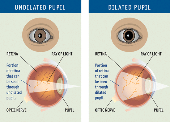 Undilated Pupil vs. Dilated Pupil