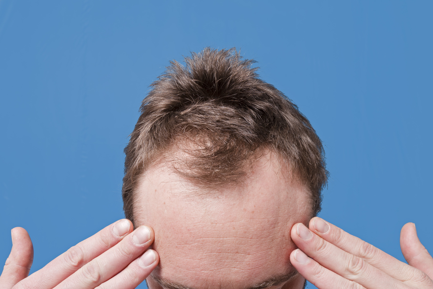 Hair Loss and Male Pattern Baldness (Androgenic Alopecia) | Young Men's  Health