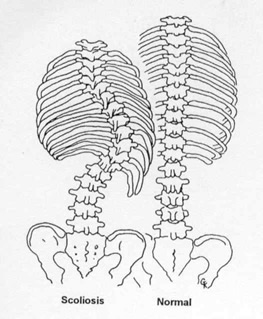 Normal Spine vs. Spine with Scoliosis