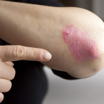 Psoriasis on elbow. Close-up